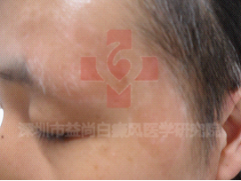深圳白癜风专科医院