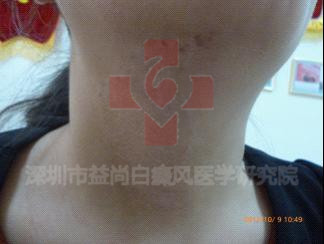 中山白癜风专科医院