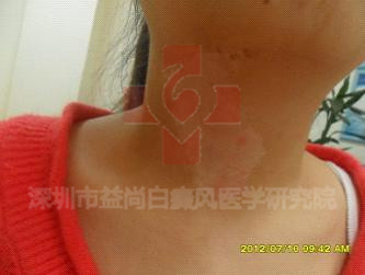 潮州白癜风专科医院