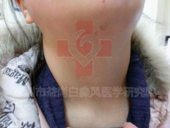 云浮白癜风专科医院