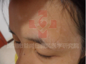 湛江白癜风医院
