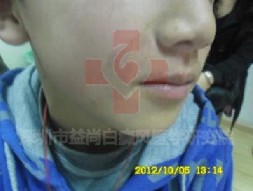 关于儿童白癜风