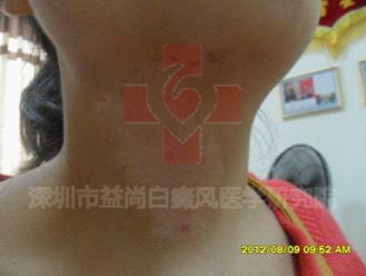 治白癜风偏方