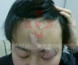 皮肤病白癜风传染吗