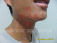 白癜风宜吃什么食物