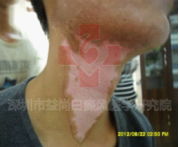 深圳哪里治疗白癜风