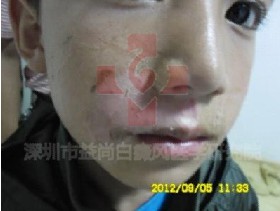 儿童为什么会患白癜风