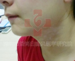 儿童能得白癜风吗