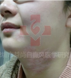 白癜风什么食物不能吃