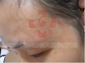 如何治疗白癜风