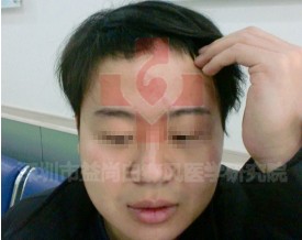 白癜风是否有遗传