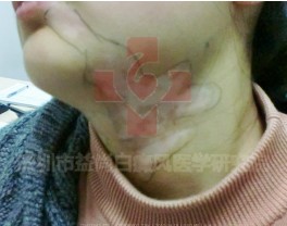 白癜风治愈后还需要注意什么