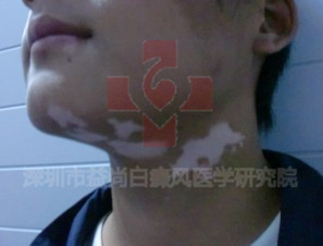 小儿白癜风传染吗