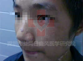 小儿白癜风传染吗