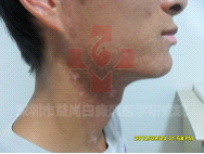 白癜风能吃些什么水果呢