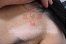 小儿白癜风的病因