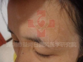小儿白癜风的病因
